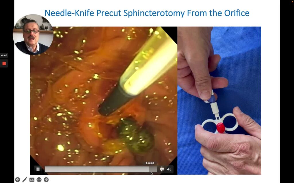 Ercp Sphincterotomy Huibregtse Needle Knife