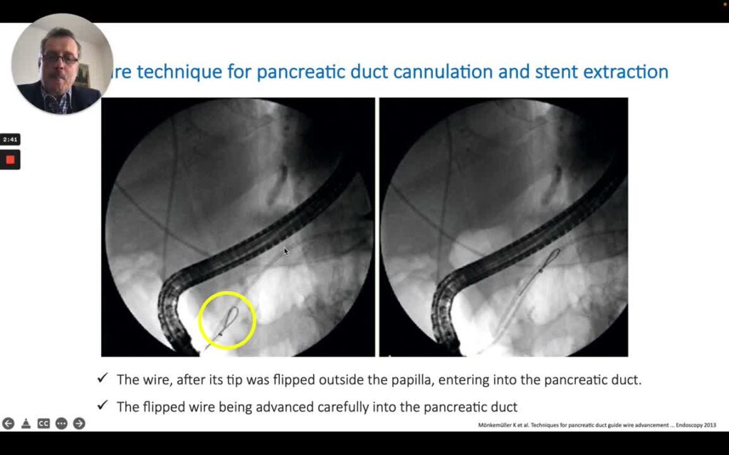 Ercp - Tips For Cannulation (U- Or Flipped Wire Technique) 3 Ercp – Tips For Cannulation (U- Or Flipped Wire Technique)