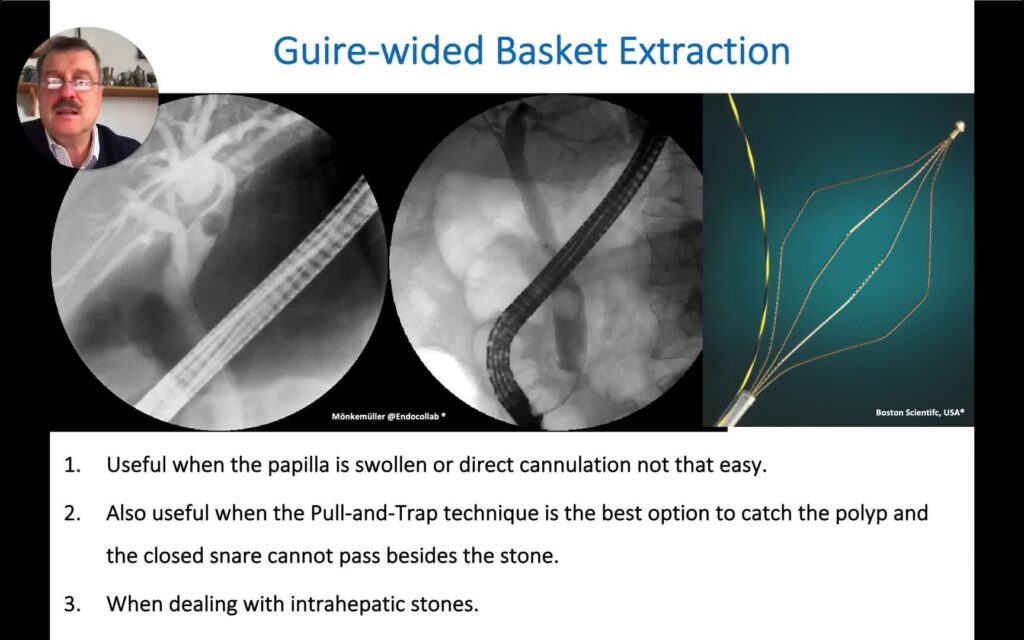 ERCP – Use of Wire-Guided Basket for Bile Duct Stone Extraction