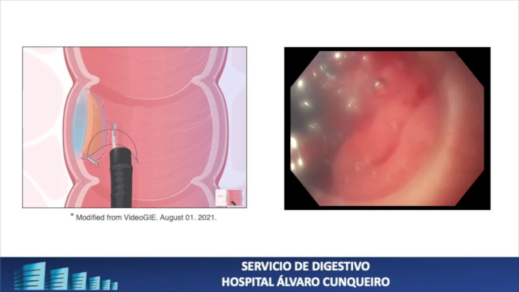 Esd Of A Gastric Lesion. Use Of Prodigi Traction Wire
