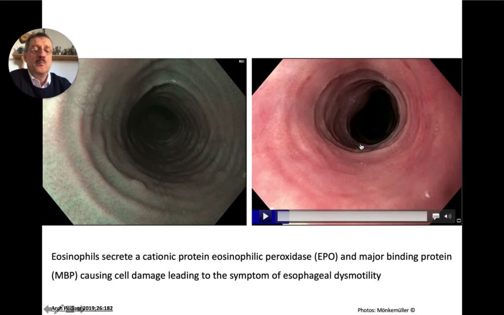 Esofagitis Eosinofílica: Enfoque En Su Diagnóstico Endoscópico 9 Esofagitis Eosinofílica: Enfoque En Su Diagnóstico Endoscópico