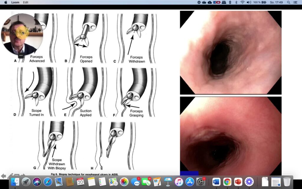 Esophageal Biopsies In The Setting Of Infectious Esophagitis