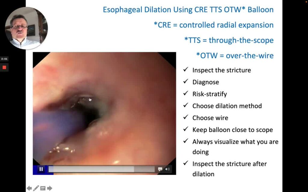 Esophageal Dilation Using a TTS-OTW-CRE (Through-the-Scope, Over-the-Wire, Controlled-Radial Expansion) Balloon