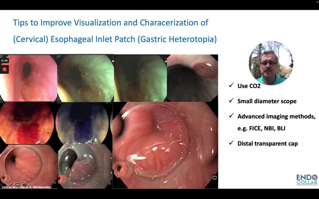 Esophageal Inlet Patch: Tips to Inspect