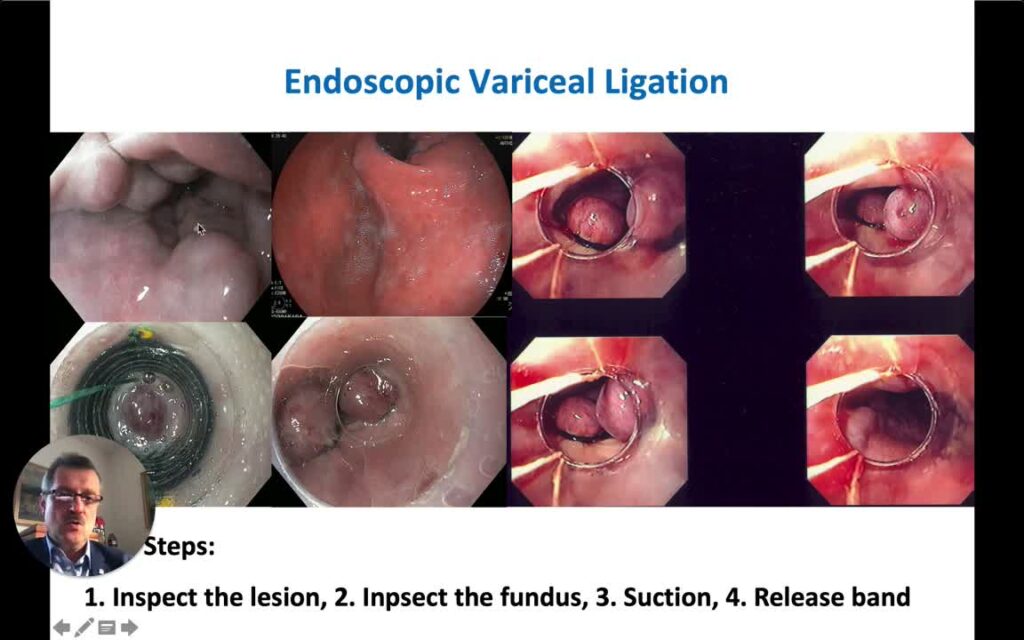 Esophageal Variceal Ligation (EVL)