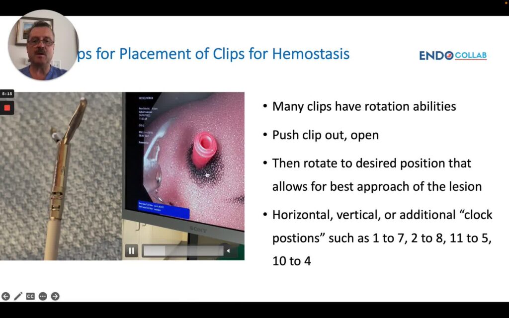 Essential Aspects For Placement Of Clips For Hemostasis