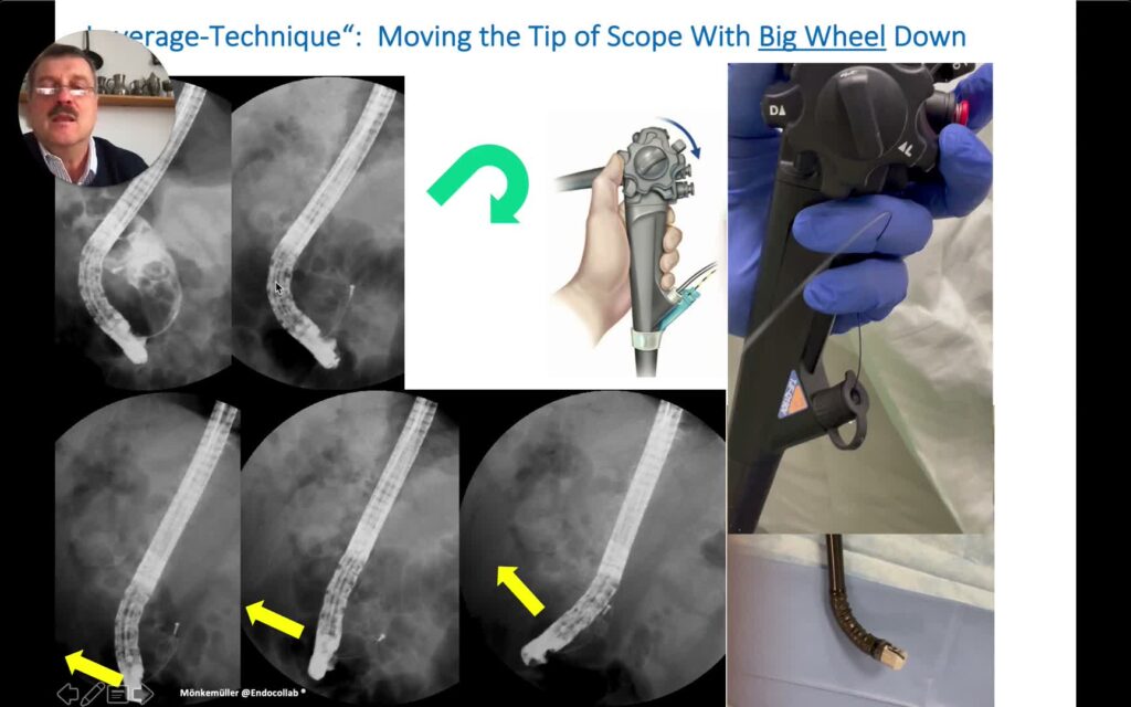 Essential Scope Positions For Stone Removal: The Leverage Movement 9 Essential Scope Positions For Stone Removal: The Leverage Movement