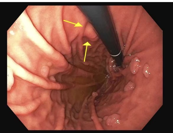 Eus Elastography (And Fnb) For Submucosl Gastric Nodules