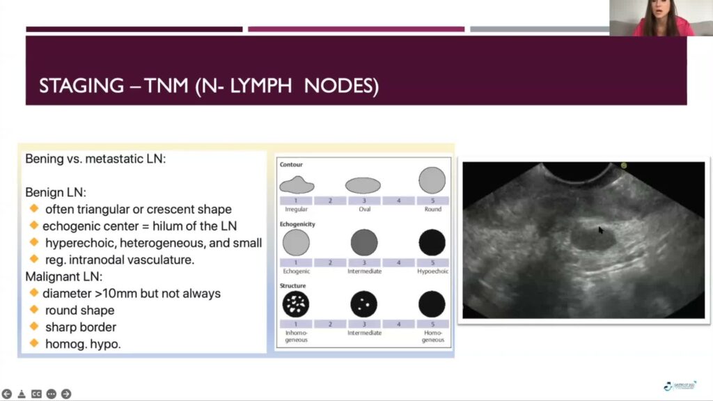 Eus For The Diagnosis Of Gastric Cancer