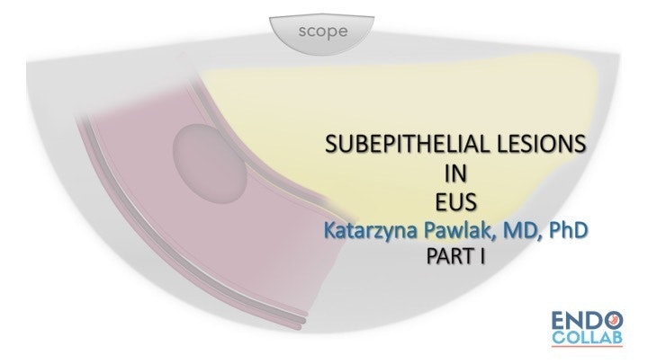 Eus For The Management Of Subepithelial Lesions Of The Gi Tract 15 Eus For The Management Of Subepithelial Lesions Of The Gi Tract