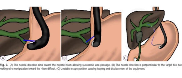 Eus-Guided Hepaticogastrostomy 5 Eus-Guided Hepaticogastrostomy