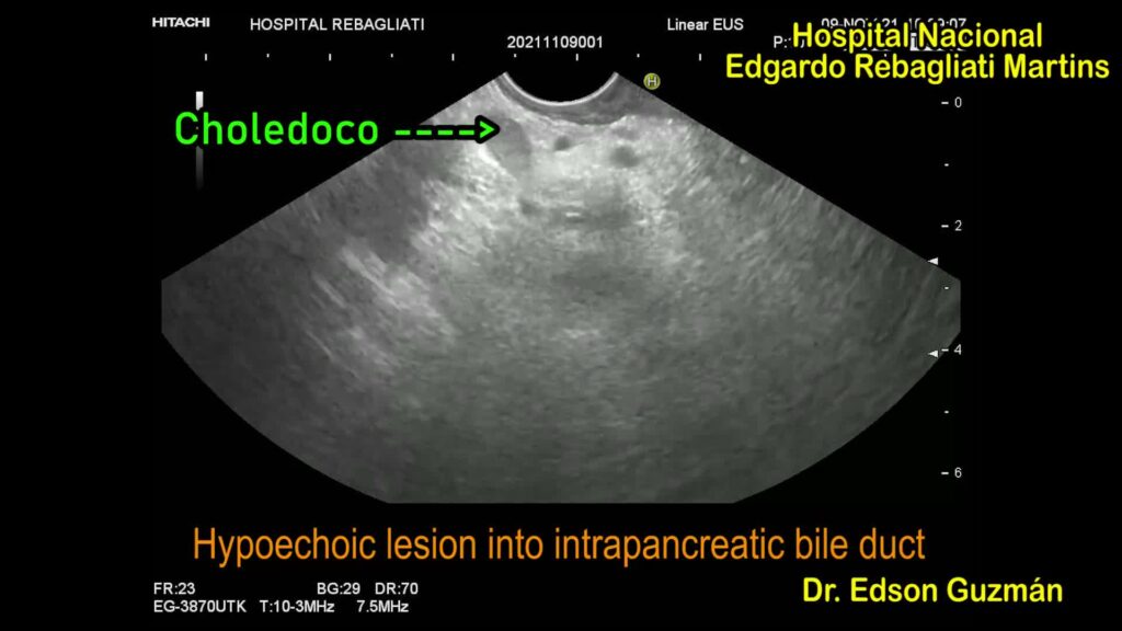 Eus In The Diagnosis Of Distal Cholangiocarcinoma By Edson Guzman Calderon