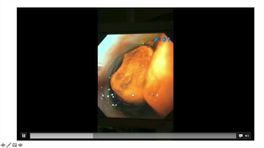 Extreme Ercp – A Quick Introduction