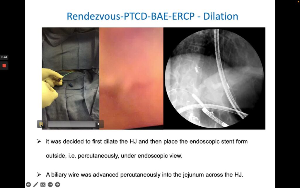 Extreme Ercp - Dbe Ercp Ptcd Rendezvous For Hj Stenosis And Cbd Stones 5 Extreme Ercp – Dbe Ercp Ptcd Rendezvous For Hj Stenosis And Cbd Stones