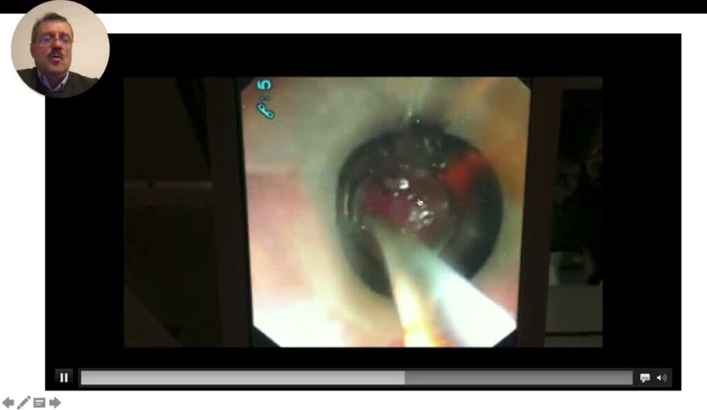 Extreme Ercp