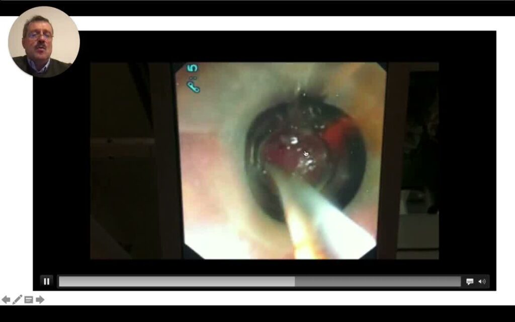 Extreme Or Level V Ercp: Definition And Some Nice Examples