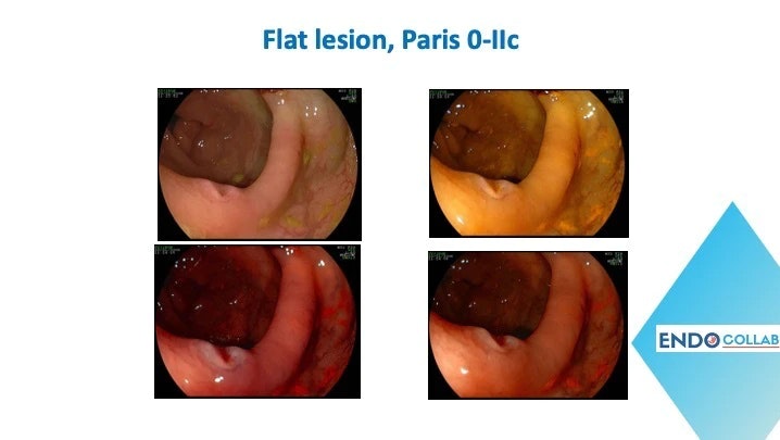 Flat Lesion, Paris 0-Iic