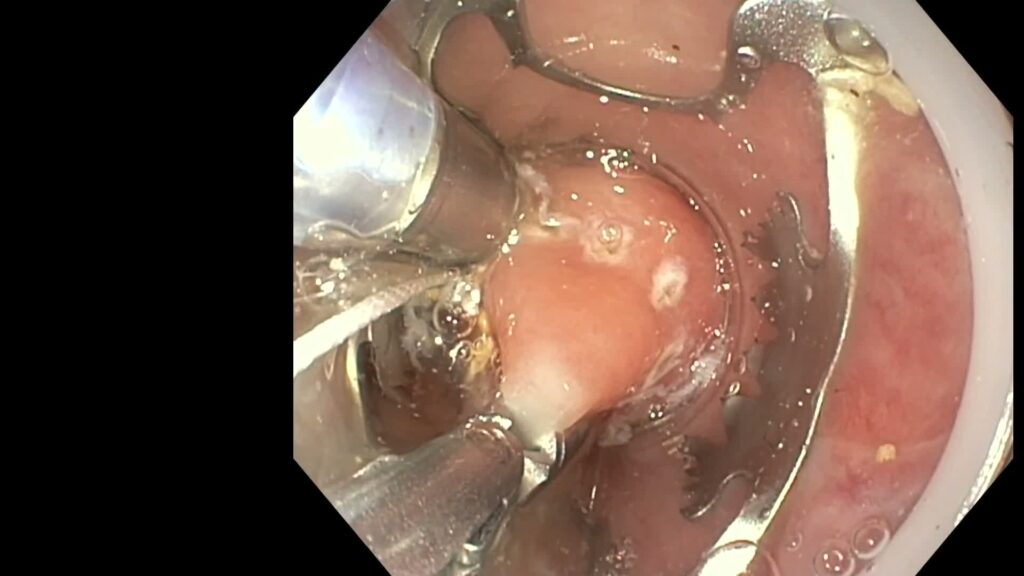 Full Thickness of a Rectal Gist