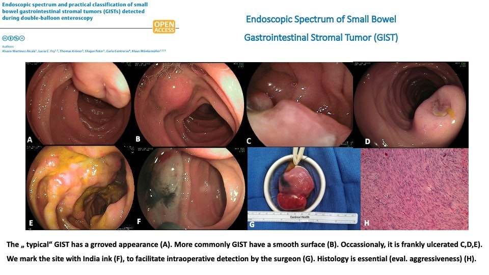 Gastrointestinal Stromal Tumor