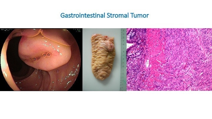 Gastrointestinal Stromal Tumor - Classic Endoscopic Appearance 17 Gastrointestinal Stromal Tumor – Classic Endoscopic Appearance