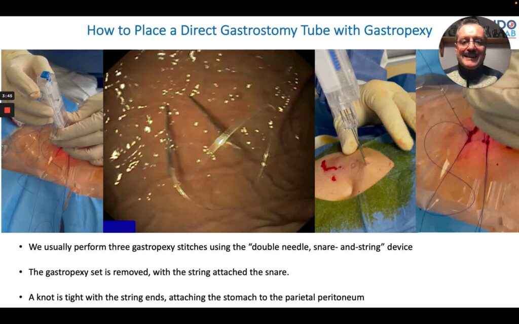 Gastropexia Y Gastrostomía Percutánea Directa 4 Gastropexia Y Gastrostomía Percutánea Directa