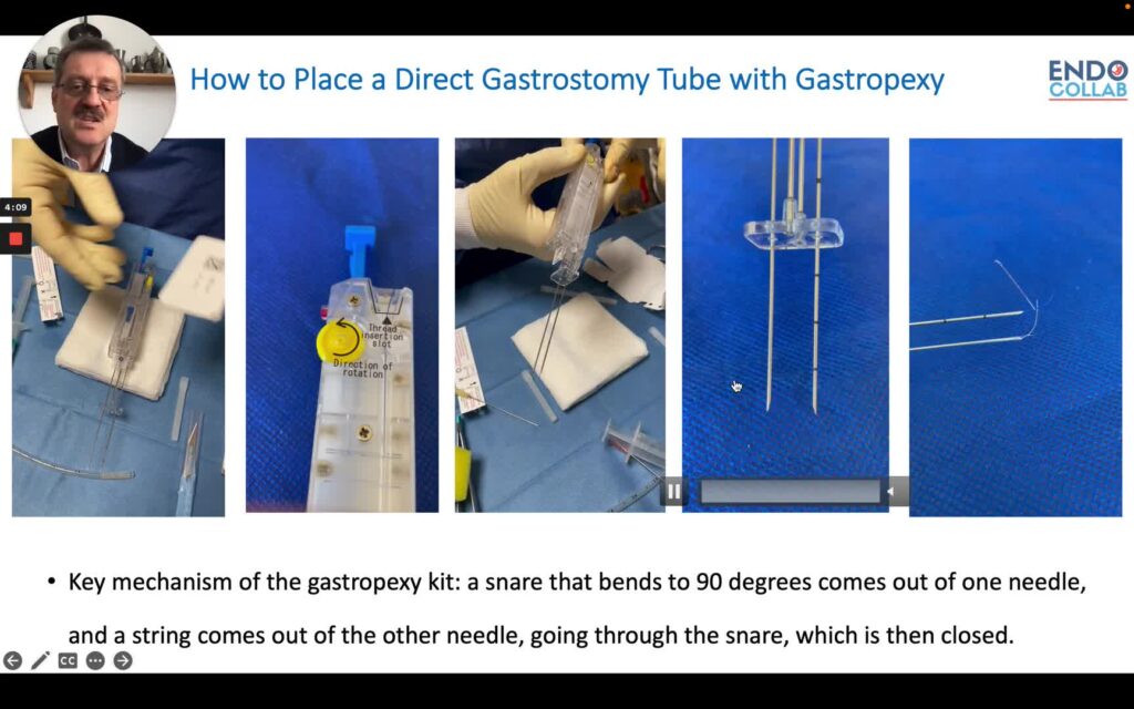 Gastropexy And Direct Gastrostomy Feeding Tube Placement Made Easy