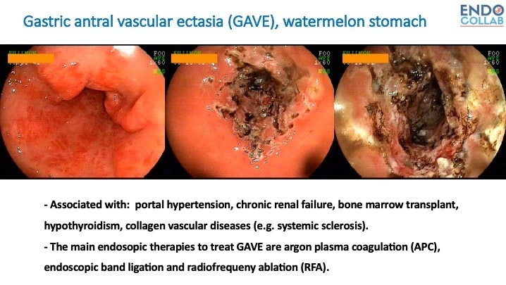 Gave, Gastric Astral Vascular Ectasia (Watermelon Stomach)