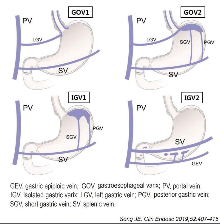 Gev, Gastric Epiploic Vein