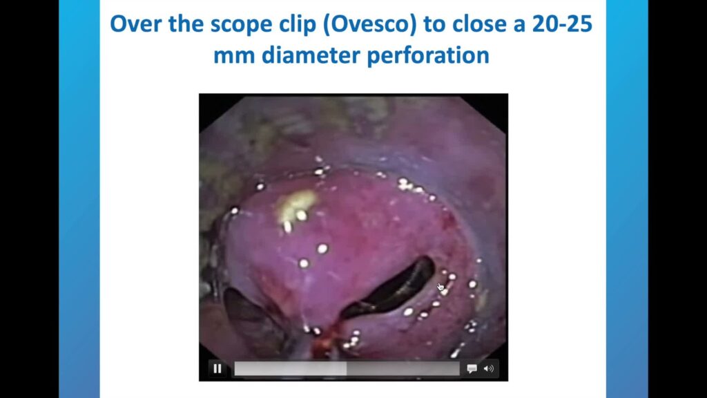 GI defectos EndoCollab