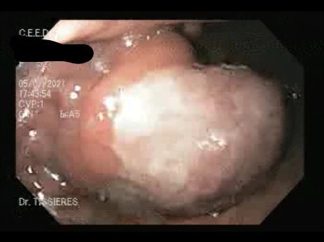 Gist Or Leiomyoma By Daniel Tissieres Ortiz