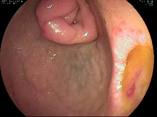 H. Pylori Positive