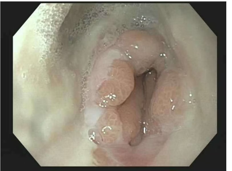Heavy Alcohol Use And Esophagitis