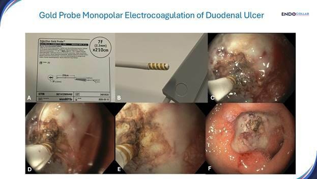 Hemostasis Of Bleeding Duodenal Ulcer Using Injection Gold Probe