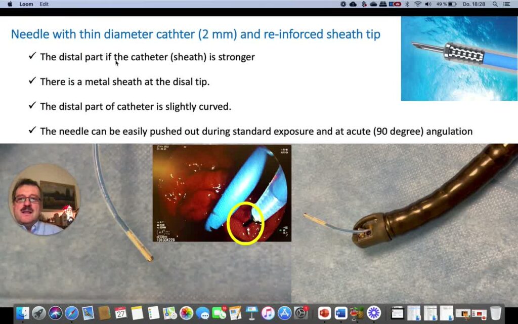 Hemostasis Using the a Thin, Distally reinforced Needle During ERCP