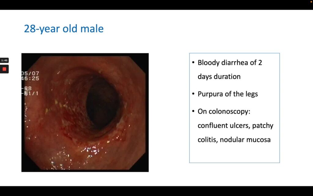 Henoch-Schönlein Purpura (Iga Vasculitis)