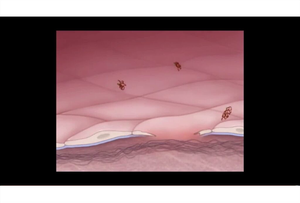 Heyde Syndrome – State-Of-The-Art