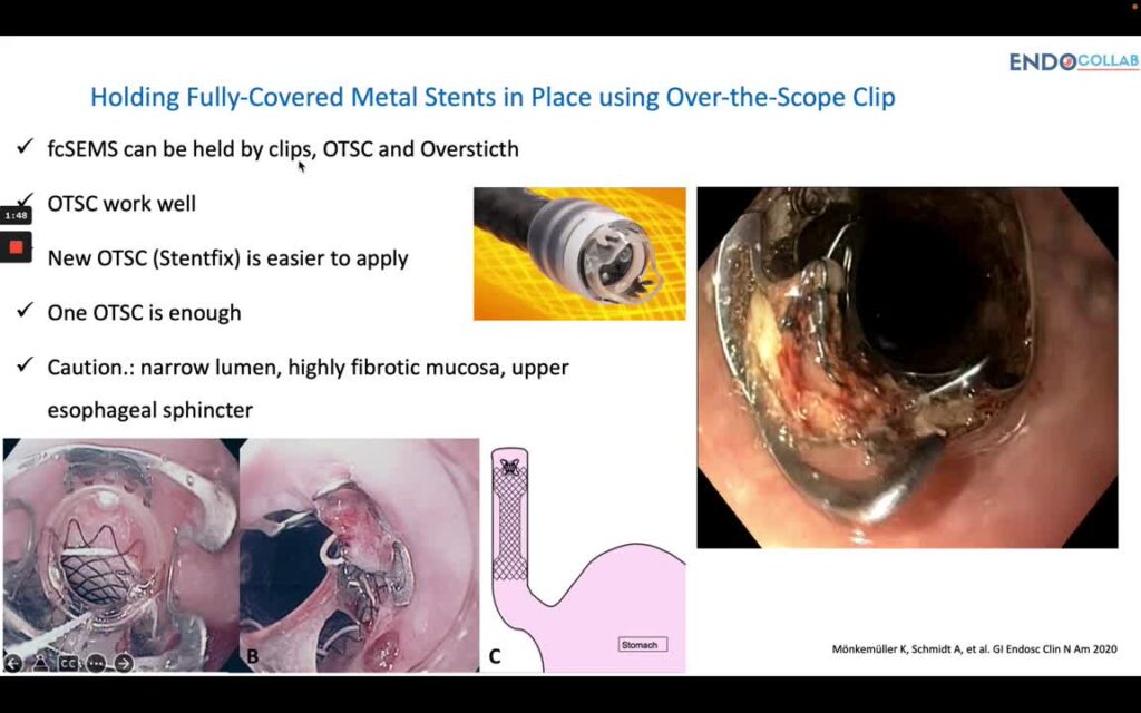 Holding Fully-Covered Metal Stents In Place Using Over-The-Scope Clip