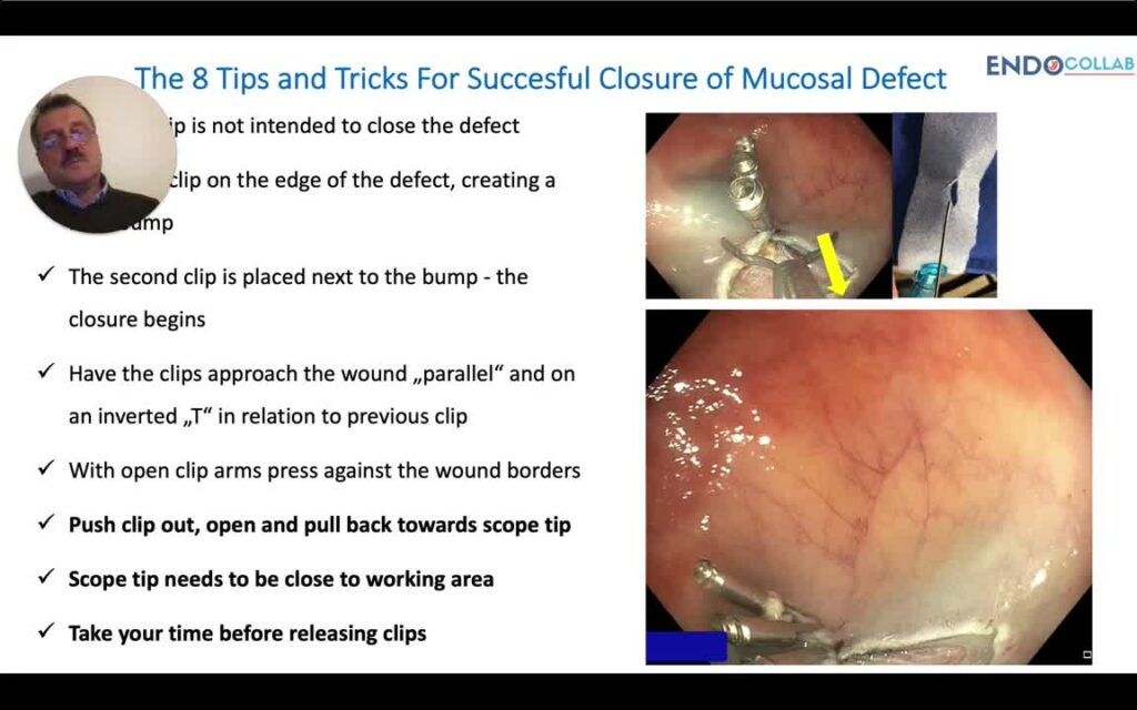How To Close A Large Mucosal Defect Using Clips