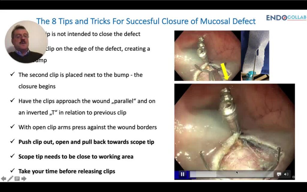 How To Close A Mucosal Defect Using Clips 9 How To Close A Mucosal Defect Using Clips