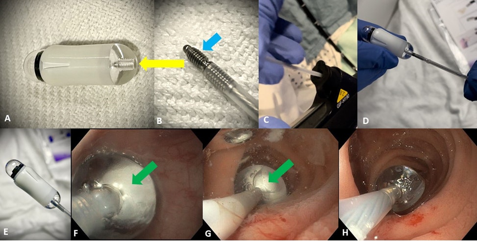 How To Deploy A Capsule Endoscope During Egd 17 How To Deploy A Capsule Endoscope During Egd