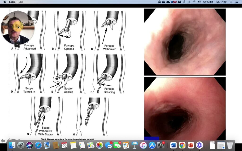 How to Obtain Biopsies in Patients with Ulcerative Esophagitis