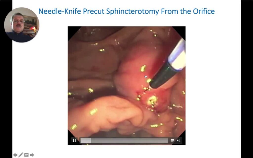 How To Perform Precut Biliary Sphincterotomy – Quick Tip Video