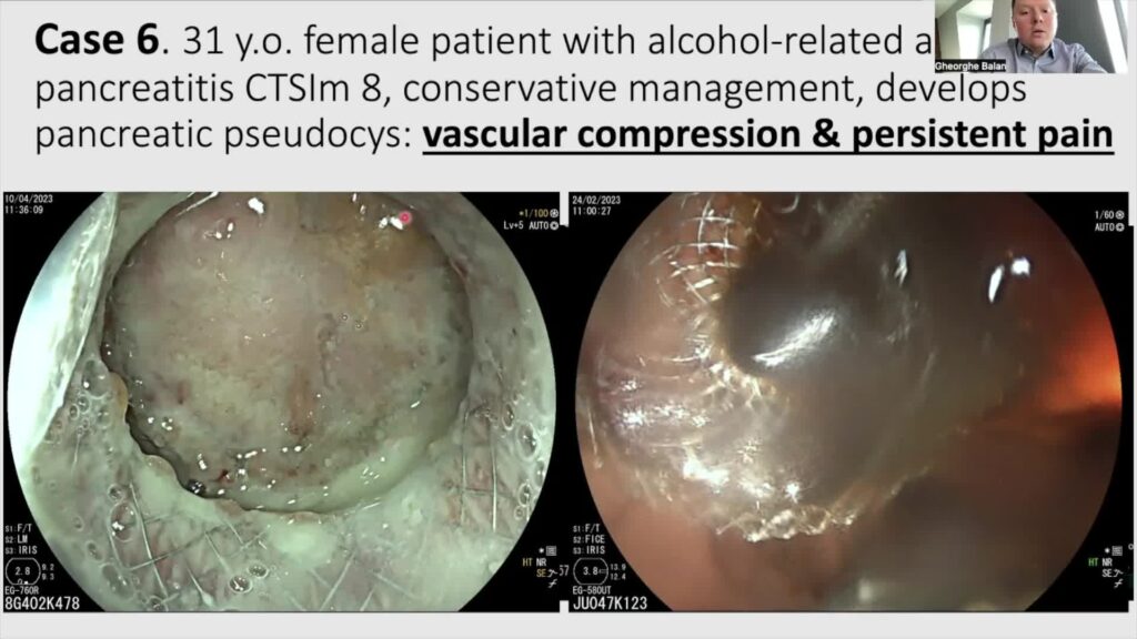 How To Properly Select Patients For Eus-Guided Drainage Of Peripancreatic Fluid Collections (Condensed Lecture) By Prof. Gheo Balan