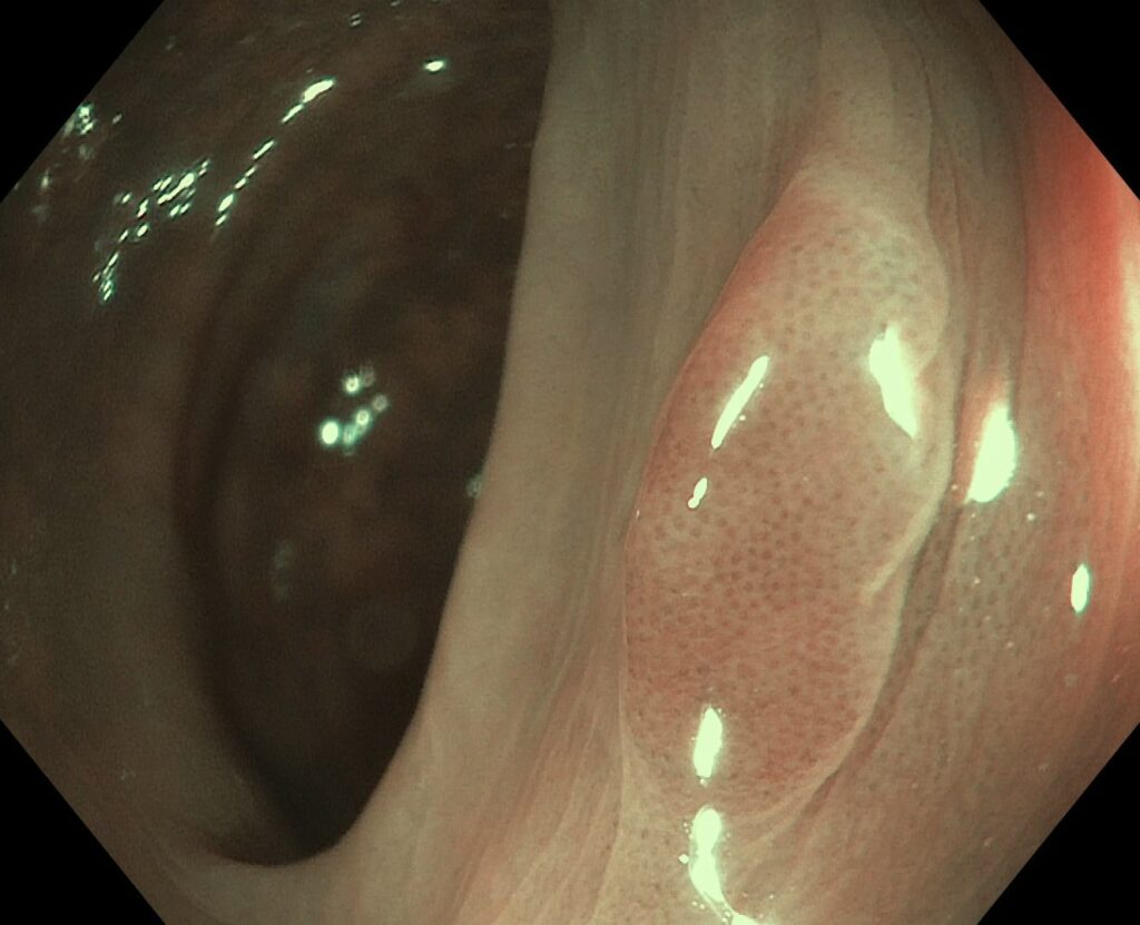 How Would You Classify This Lesion Based On Jnet? 14 How Would You Classify This Lesion Based On Jnet?