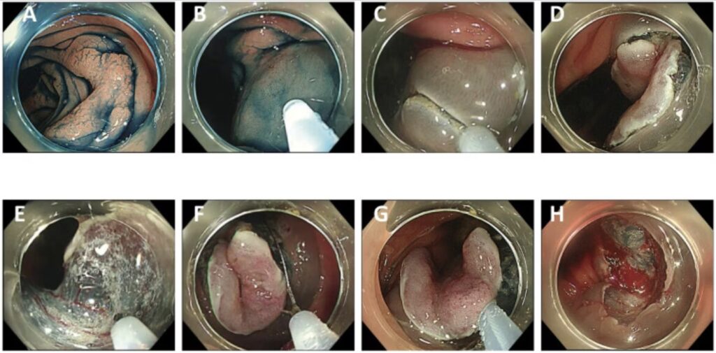 Hybrid Esd-Emr For Colorectal Lesions 11 Hybrid Esd-Emr For Colorectal Lesions
