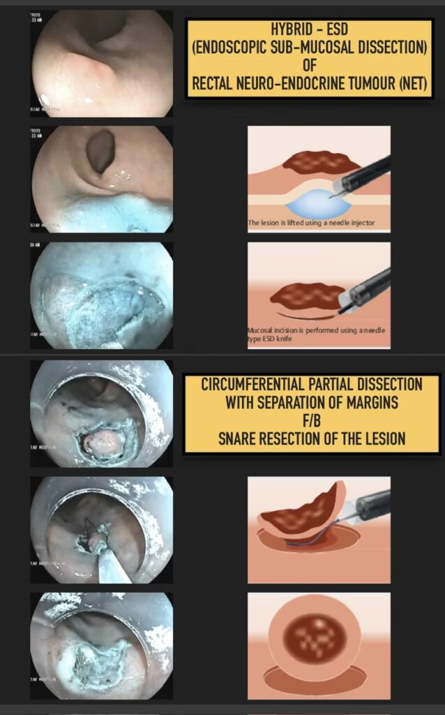 Hybrid Esd (Endoscopic Submucosal Dissection ) For Rectal Net 13 Hybrid Esd (Endoscopic Submucosal Dissection ) For Rectal Net