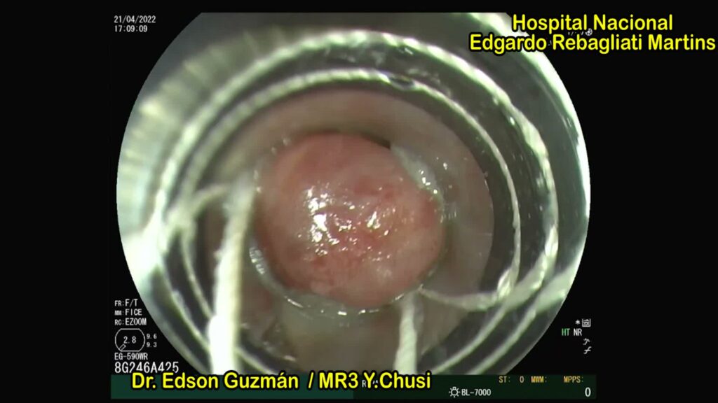 Image Squence: Endoscopic Band Ligation Of Esophageal Varices By Edson Guzman Calderon
