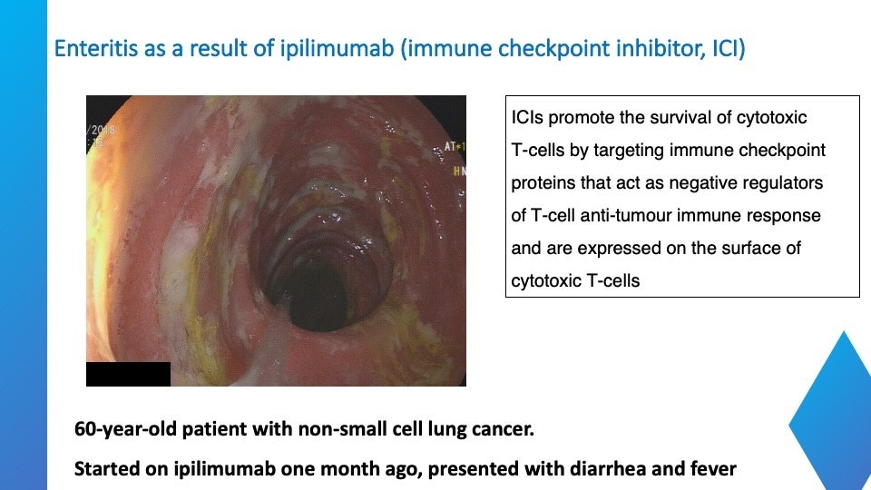 Immune Checkpoint Inhibitor