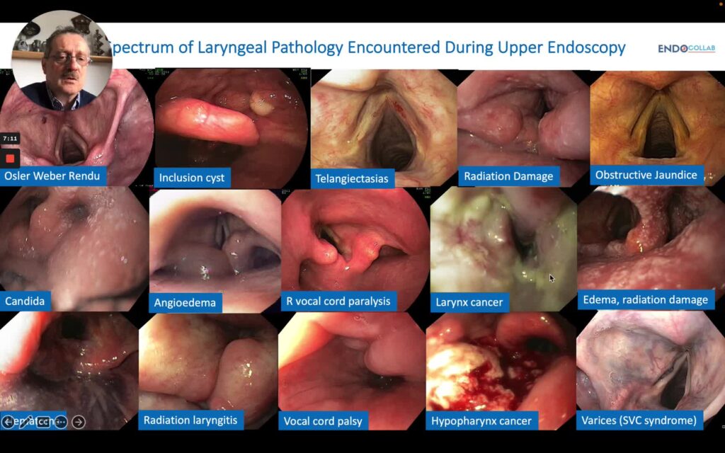 Inspection of the Hypopharynx and Larynx During EGD- an Endoscopic Atlas