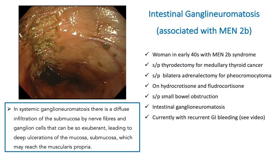 Intestinal Ganglioneuromatosis By Prof. Dr Carolina Olano